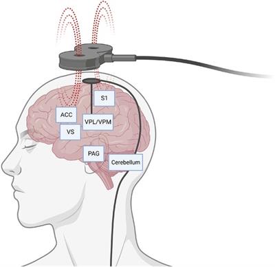 Editorial: Advancements in deep brain stimulation for chronic pain control